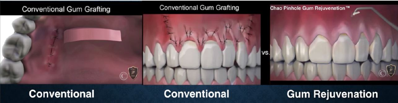 Conventional Gum Grafting without Pinhole